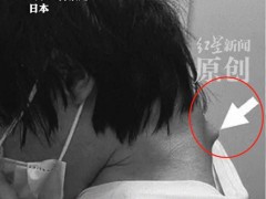 终于了解日本25岁男子沉迷手游致脖子长角 低头族警钟