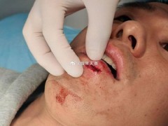 曝侯森缝了23针乘坐火车返回北京 伤情严重不宜飞行