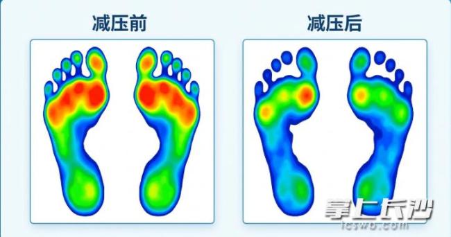 33岁&ldquo;糖友&rdquo;脚底反复溃烂