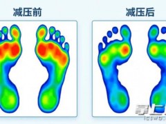 33岁“糖友”脚底反复溃烂 足部畸形导致(图)